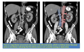There is a hyperdense concrement (red circle) in the left renal pelvis, which is a kidney stone. The renal
pelvis is not dilated, indicating that the kidney stone is not currently causing an obstruction.
 