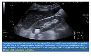 Transhepatic longitudinal ultrasound of the right kidney: There is a round, hyperechoic lesion (green area) at
the upper pole of the kidney in the renal parenchyma, which shows a dorsal acoustic shadow (white area)
and is most likely a kidney stone. The central areas of the kidney show, as far as can be seen in this image, no
dilation, which indicates no obstruction.
 