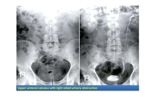 Upper ureteral calculus with right-sided urinary obstruction
 