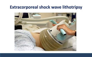 Extracorporeal shock wave lithotripsy
 