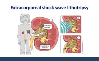 Extracorporeal shock wave lithotripsy
 