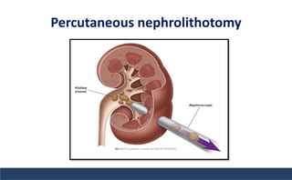 Percutaneous nephrolithotomy
 