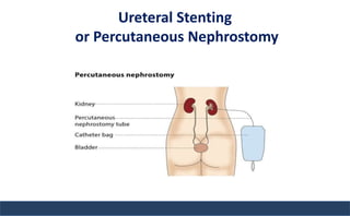 Ureteral Stenting
or Percutaneous Nephrostomy
 