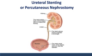 Ureteral Stenting
or Percutaneous Nephrostomy
 