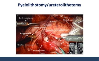 Pyelolithotomy/ureterolithotomy
 