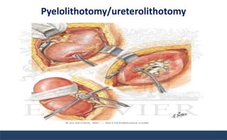 Pyelolithotomy/ureterolithotomy
 