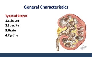 General Characteristics
Types of Stones
1.Calcium
2.Struvite
3.Urate
4.Cystine
 