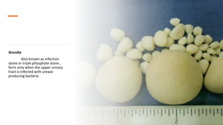 Nephrolithiasis_SHISODIA.pptx.pptx