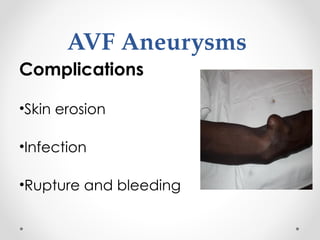 Comprehensive Guide to Vascular Access for Dialysis Nurses: Techniques ...