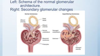 Left: Schema of the normal glomerular
architecture.
Right: Secondary glomerular changes
 