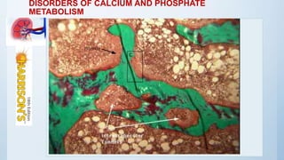 DISORDERS OF CALCIUM AND PHOSPHATE
METABOLISM
Osteitis fibrosa cystica
 bone turnover
 abnormal histology
 brown tumor
Low-turnover bone disease can be
grouped into two categories:
1. adynamic bone disease
2. and osteomalacia
 