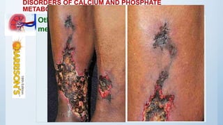 DISORDERS OF CALCIUM AND PHOSPHATE
METABOLISM
Other complications of abnormal mineral
metabolism:
• Calciphylaxis (calcific uremic arteriolopathy)
• Other etiologies
• use of oral calcium as a phosphate binder
• Warfarin
 