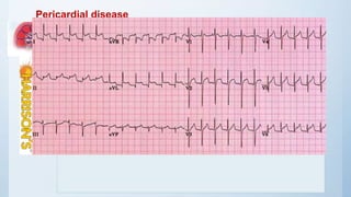 Pericardial disease
Chest pain with respiratory accentuation, accompanied
by a friction rub, is diagnostic of pericarditis.
Classic electrocardiographic abnormalities include PR-
interval depression and diffuse ST-segment elevation
Initiation of dialysis
No heparin
 