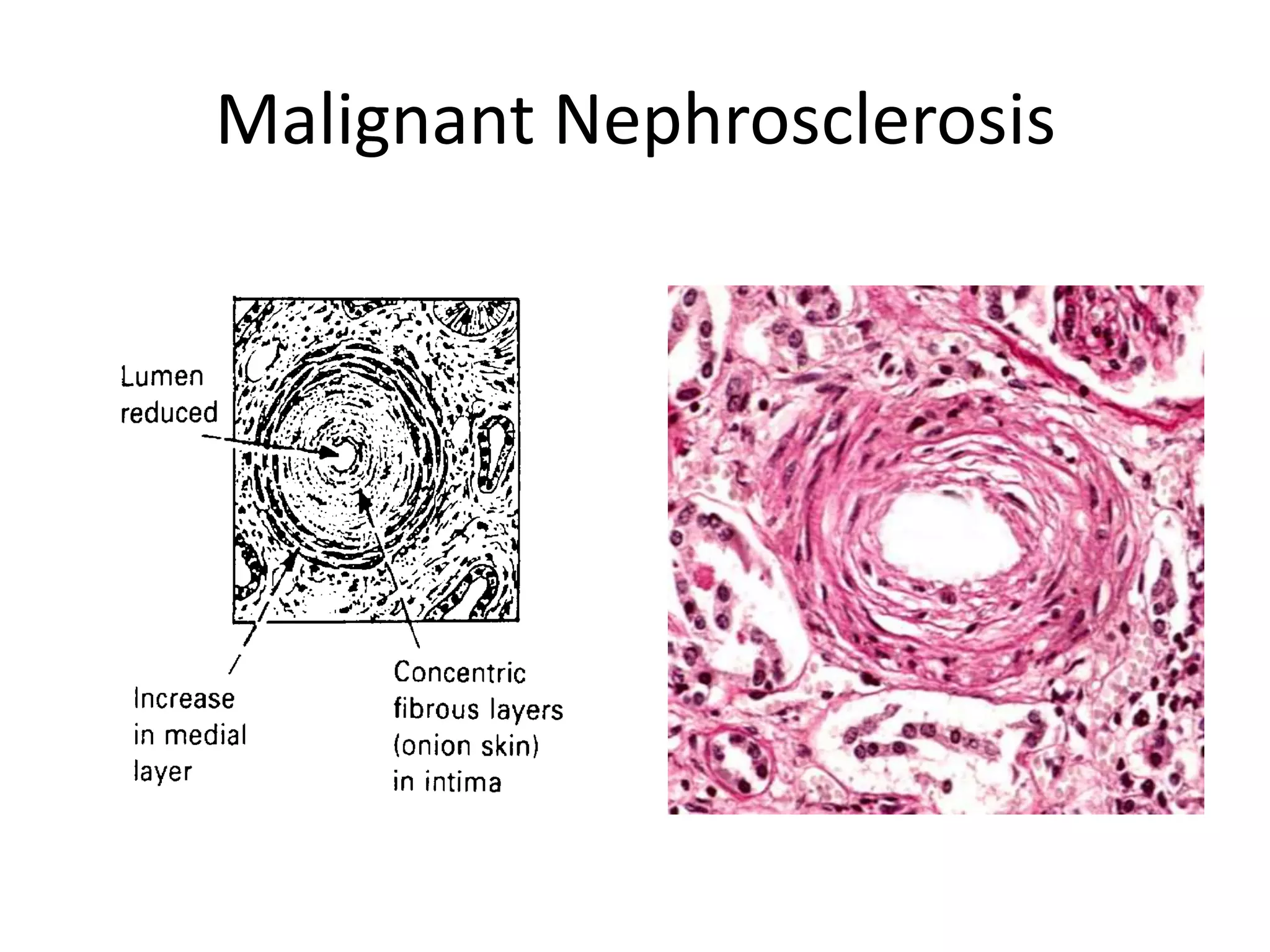 Nephrosclerosis | PPT