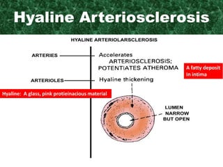 Hyaline Arteriosclerosis
A fatty deposit
In intima
Hyaline: A glass, pink protieinacious material
 
