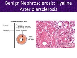 Benign Nephrosclerosis: Hyaline
Arteriolarsclerosis
 