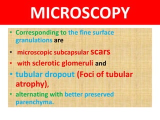 MICROSCOPY
• Corresponding to the fine surface
granulations are
• microscopic subcapsular scars
• with sclerotic glomeruli and
• tubular dropout (Foci of tubular
atrophy),
• alternating with better preserved
parenchyma.
 