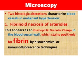 Microscopy
• Two histologic alterations characterize blood
vessels in malignant hypertension:
1. Fibrinoid necrosis of arterioles.
This appears as an Eosinophilic Granular Change in
the blood vessel wall, which stains positively
for fibrin by histochemical or
immunofluorescence techniques.
 