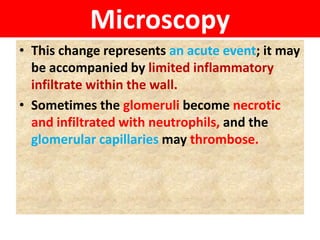 Microscopy
• This change represents an acute event; it may
be accompanied by limited inflammatory
infiltrate within the wall.
• Sometimes the glomeruli become necrotic
and infiltrated with neutrophils, and the
glomerular capillaries may thrombose.
 