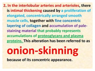 2. In the interlobular arteries and arterioles, there
is intimal thickening caused by a proliferation of
elongated, concentrically arranged smooth
muscle cells, together with fine concentric
layering of collagen and accumulation of pale-
staining material that probably represents
accumulations of proteoglycans and plasma
proteins. This alteration has been referred to as
onion-skinning
because of its concentric appearance.
 