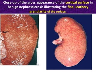 Close-up of the gross appearance of the cortical surface in
benign nephrosclerosis illustrating the fine, leathery
granularity of the surface.
 