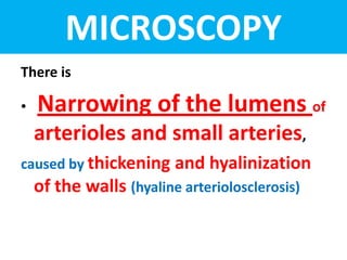 MICROSCOPY
There is
• Narrowing of the lumens of
arterioles and small arteries,
caused by thickening and hyalinization
of the walls (hyaline arteriolosclerosis)
 