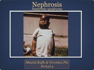 Nephrosis

Nephrotic syndrome

Sheetal Kafle & Veronica Pin
Period 4

 