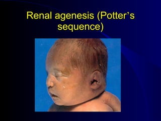 Potter's Classification nephrotic syndrom and UTI | PPT