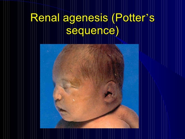 nephrotic syndrom and UTI