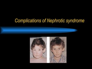 Complications of Nephrotic syndrome  