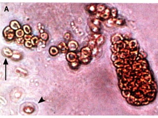 Nephrotic And Nephritic Syndrome 2008 | PPT