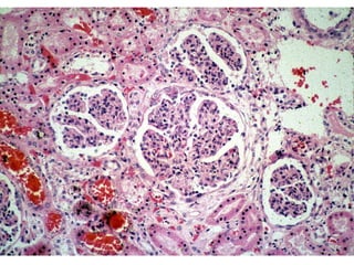 Nephrotic And Nephritic Syndrome 2008 | PPT