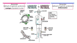 Remember
Hallmark of nephrotic syndrome is
Leakage of proteins in urine
Remember
Hallmark of nephritic syndrome is
Inflammation
 