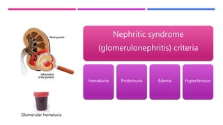Nephritic syndrome
(glomerulonephritis) criteria
Hematuria Proteinuria Edema Hypertension
Glomerular hematuria
 