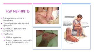 HSP NEPHRITIS
 IgA-containing immune
complexes
 Typically occurs after systemic
symptoms
 Glomerular hematuria and
proteinuria
 Treatment:
 Mild → supportive
 Severe or persistent → steroids
and/or immunosuppressive
agents
 