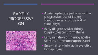 RAPIDLY
PROGRESSIVE
GN
 Acute nephritic syndrome with a
progressive loss of kidney
function over short period of
time (days)
 Early diagnosis with kidney
biopsy (crescent formation)
 Early initiation of therapy (pulse
steroids + immunosuppression)
 Essential to minimize irreversible
kidney injury
 