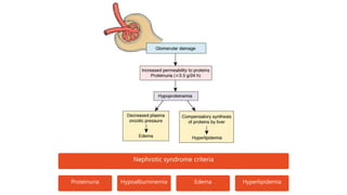 Nephrotic syndrome criteria
Proteinuria Hypoalbuminemia Edema Hyperlipidemia
 