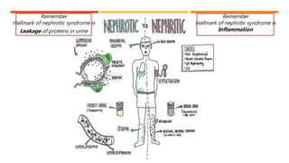 Remember
Hallmark of nephrotic syndrome is
Leakage of proteins in urine
Remember
Hallmark of nephritic syndrome is
Inflammation
 