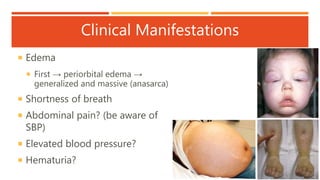 Clinical Manifestations
 Edema
 First → periorbital edema →
generalized and massive (anasarca)
 Shortness of breath
 Abdominal pain? (be aware of
SBP)
 Elevated blood pressure?
 Hematuria?
 