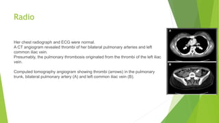 Radio
Her chest radiograph and ECG were normal.
A CT angiogram revealed thrombi of her bilateral pulmonary arteries and left
common iliac vein.
Presumably, the pulmonary thrombosis originated from the thrombi of the left iliac
vein.
Computed tomography angiogram showing thrombi (arrows) in the pulmonary
trunk, bilateral pulmonary artery (A) and left common iliac vein (B).
 