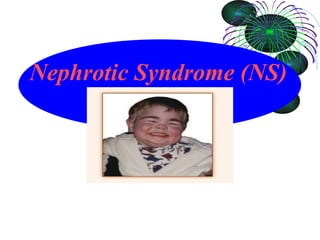 Nephrotic Syndrome (NS) 