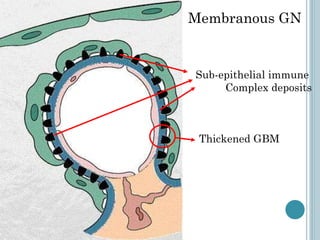 Membranous GN Sub-epithelial immune  Complex deposits Thickened GBM 