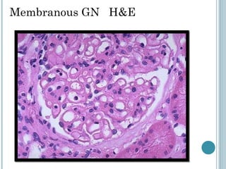 Membranous GN  H&E 