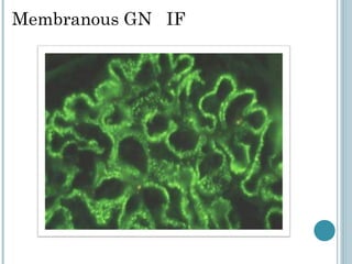 Membranous GN  IF 