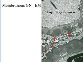 Capillary Lumen GBM GBM Membranous GN  EM 