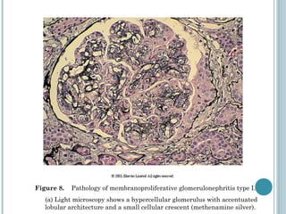 Figure 8.  Pathology of membranoproliferative glomerulonephritis type I.  (a) Light microscopy shows a hypercellular glomerulus with accentuated lobular architecture and a small cellular crescent (methenamine silver).  