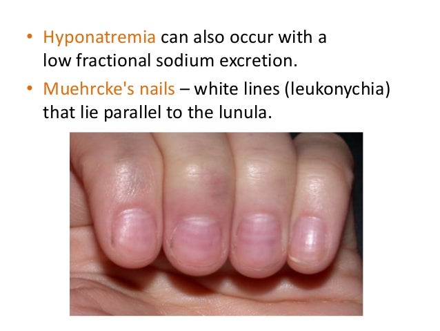 Nephrotic syndrome