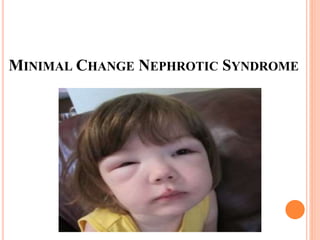 MINIMAL CHANGE NEPHROTIC SYNDROME
 