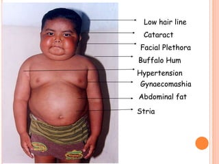 Low hair line
Cataract
Facial Plethora
Buffalo Hum
Gynaecomashia
Stria
Hypertension
Abdominal fat
 
