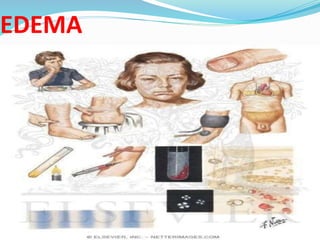 EDEMA
 